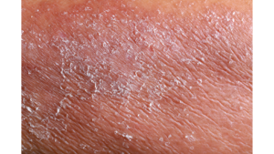 Eczema Symptoms: Causes and Effective Treatments