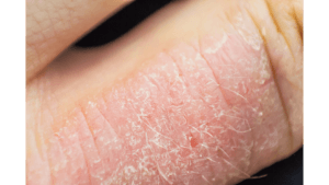 Eczema Symptoms: Causes and Effective Treatments