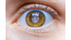 Cataracts: Symptoms, Causes and Treatment