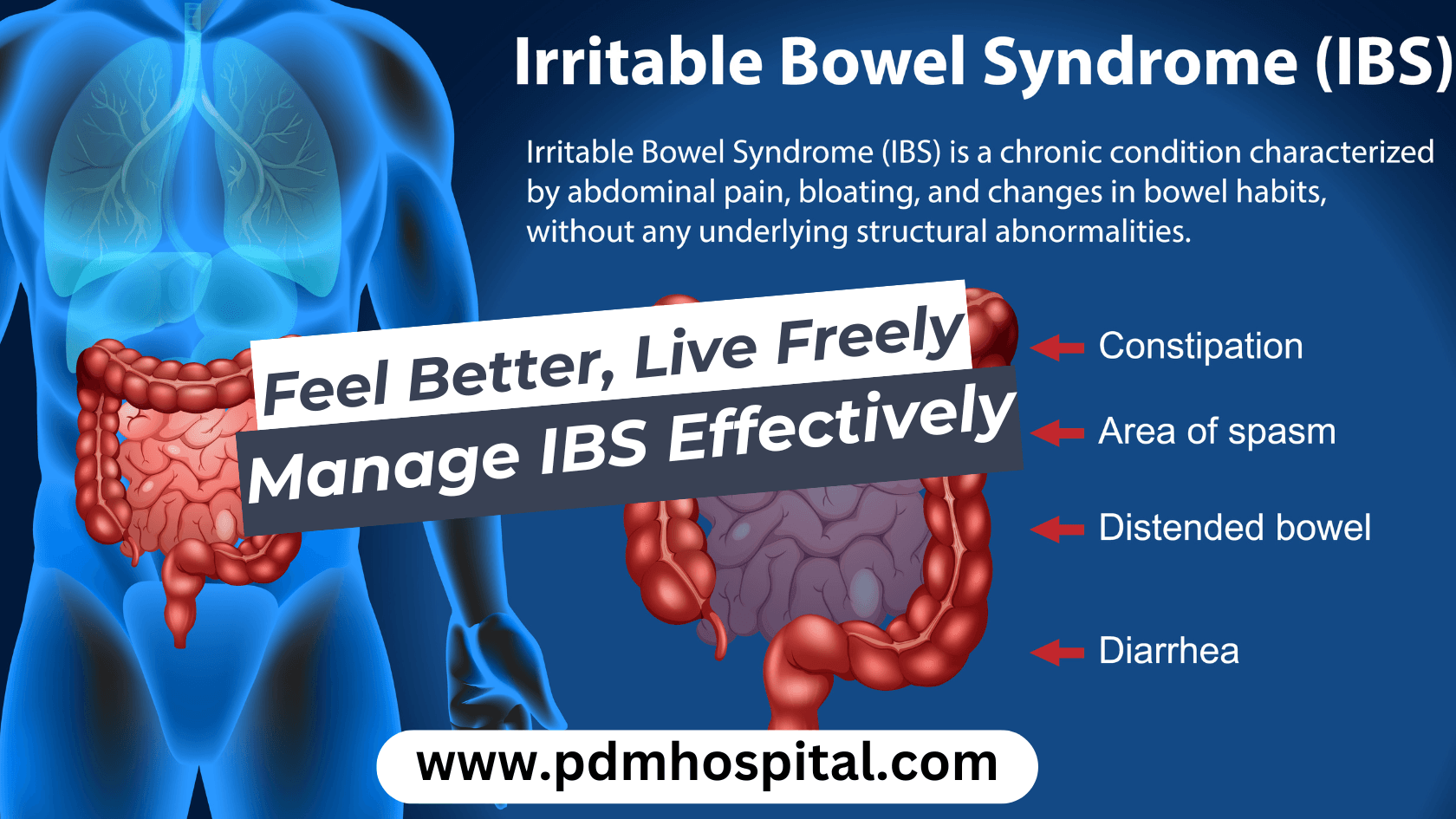 Irritable Bowel Syndrome: Symptoms and Homeopathic Treatment