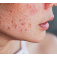 Acne Symptoms