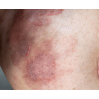 Ringworm Symptoms