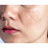 Melasma Treatment at PDM Homeopathy Hospital