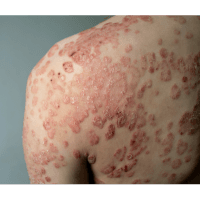 Psoriasis Treatment at PDM Hospital