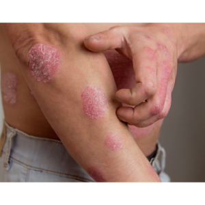 Skin Disorders: Psoriasis, Eczema, Acne