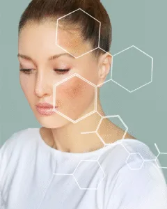 Over-exfoliation damaging skin barrier – acne care tips