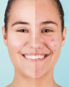 Minimalist skincare routine for acne-prone skin – homeopathic guidance