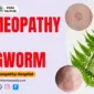 Homeopathy for Ringworm: An Effective, Lasting Solution - PDM Homeopathy