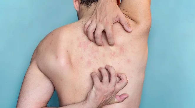 Psoriasis